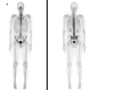 Bone Scan 1.jpg