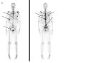 Bone Scan 2.jpg